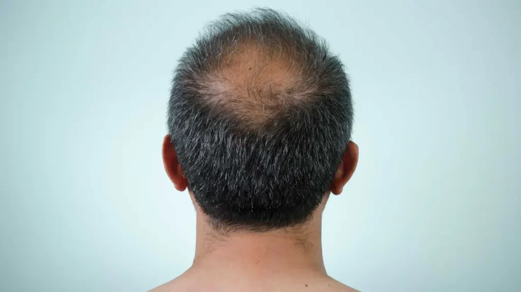 male pattern baldness 1296x728 header